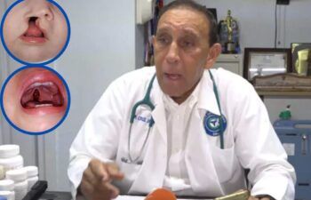 Jiminián anuncia operación gratuita a niños con labio leporino y paladar hendido