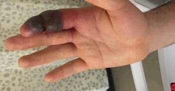 Hombre fue mordido por serpiente venenosa a la que salvó de ser arrollada