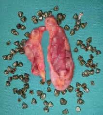 Le extraen casi 100 piedras de la vesícula