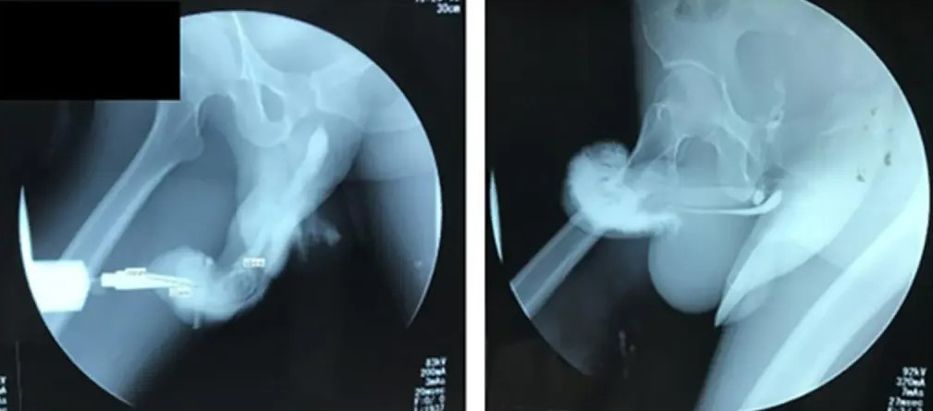 Hombre se fracturó el pene mientras practicaba la “vaquera invertida”