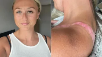 Compró un top por $7.000 en Shein y terminó con una grave quemadura